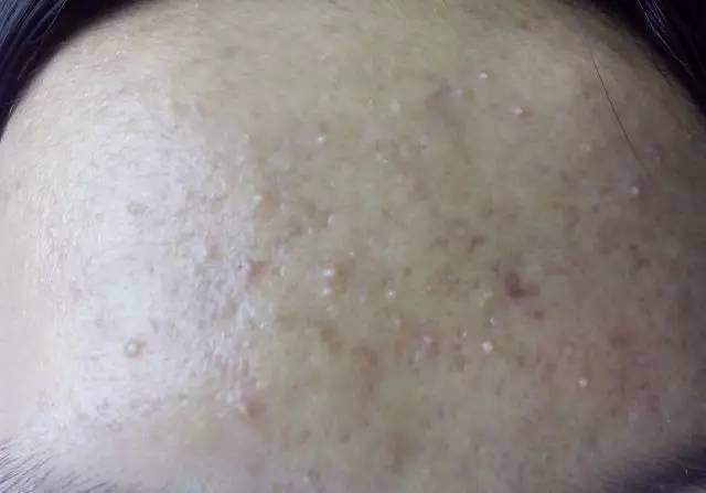 最全战痘攻略,战痘100种祛痘方法