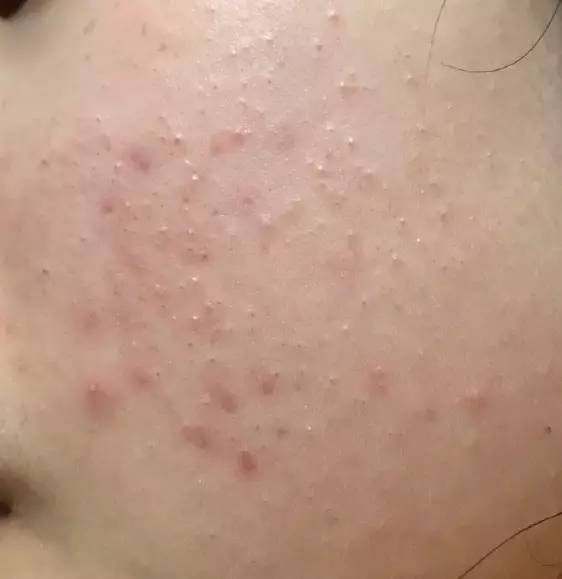 最全战痘攻略,战痘100种祛痘方法