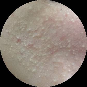 最全战痘攻略,战痘100种祛痘方法