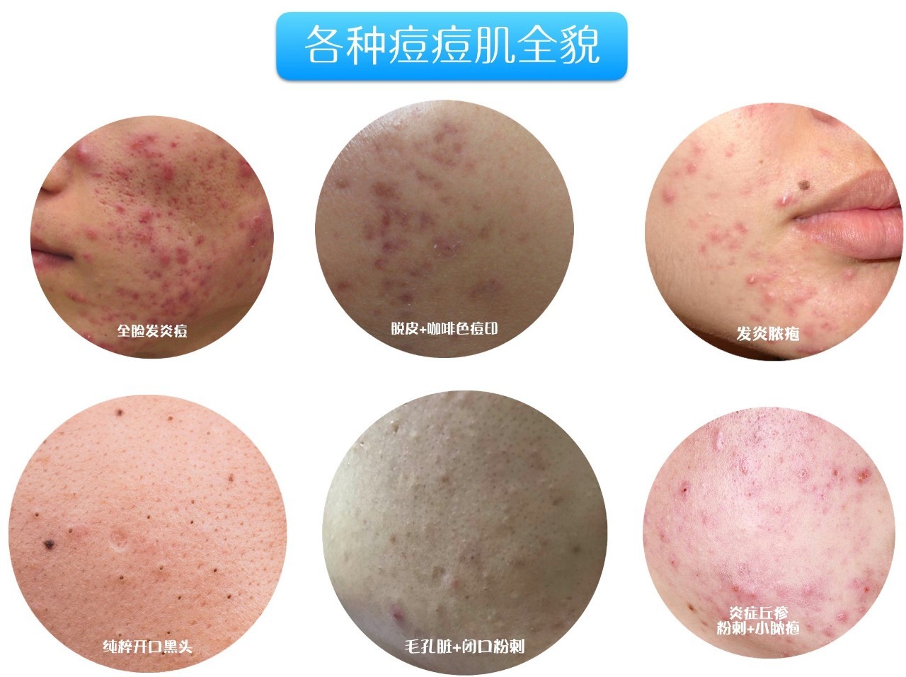 最全战痘攻略,战痘100种祛痘方法