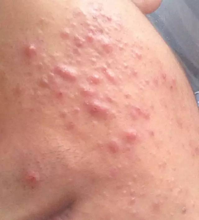 最全战痘攻略,战痘100种祛痘方法