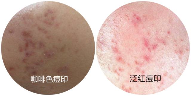 最全战痘攻略,战痘100种祛痘方法