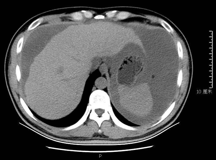 腹胀是怎么回事谨慎是这里生病了,腹胀是什么原因引起的胃不舒服