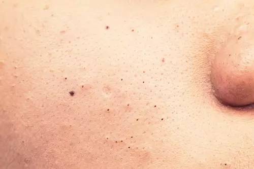 最全战痘攻略,战痘100种祛痘方法