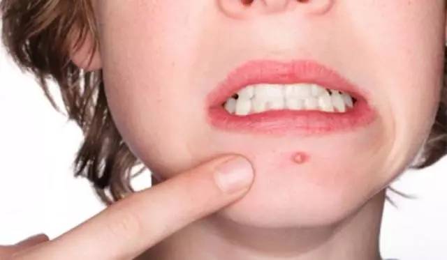 最全战痘攻略,战痘100种祛痘方法