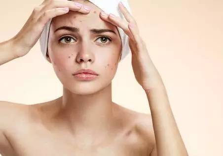 最全战痘攻略,战痘100种祛痘方法