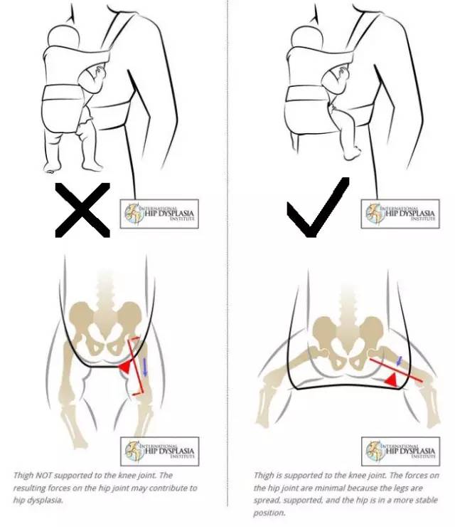 初中孩子腿不直怎么矫正腿型,17岁孩子腿不直怎么矫正