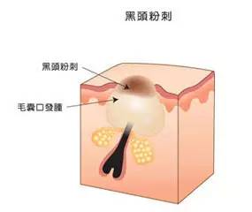 最全战痘攻略,战痘100种祛痘方法