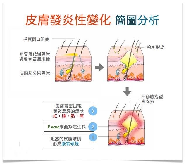最全战痘攻略,战痘100种祛痘方法