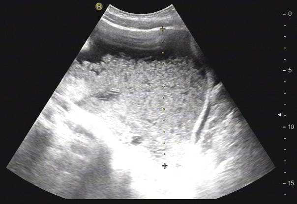 腹胀是怎么回事谨慎是这里生病了,腹胀是什么原因引起的胃不舒服