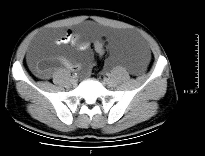 腹胀是怎么回事谨慎是这里生病了,腹胀是什么原因引起的胃不舒服