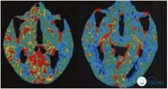 高龄颈动脉狭窄治疗,颈动脉高灌注综合征