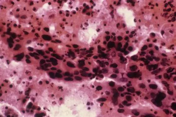 癌症疫苗何时问世,女性癌症疫苗9价多少钱