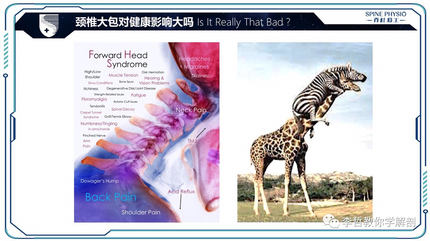 24度颈部大包怎么去除,颈后大包通过训练消除