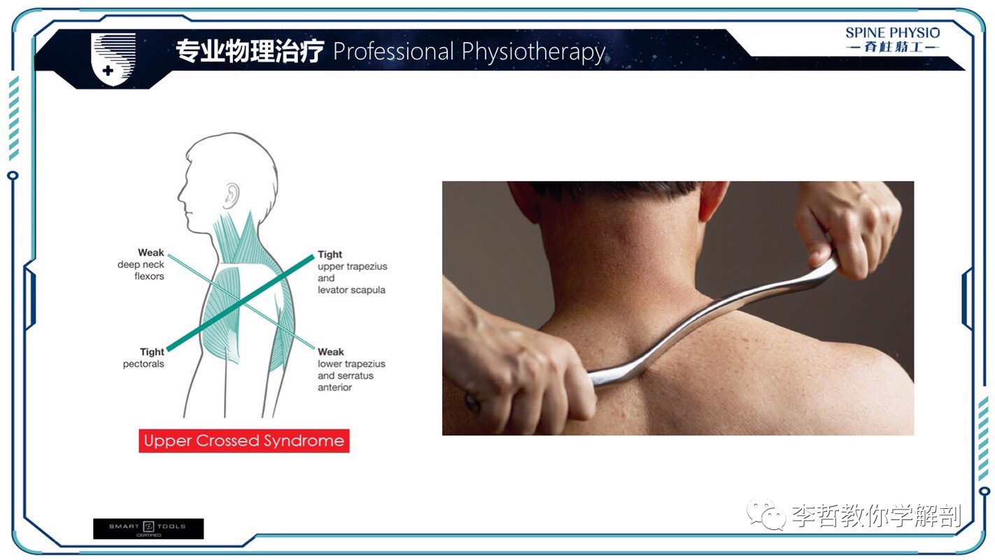 24度颈部大包怎么去除,颈后大包通过训练消除