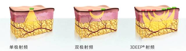 好物黑科技产品,以色列射频美容仪川字纹