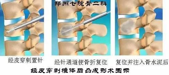 骨科微创手术科普,骨科康复医院一天费用400左右