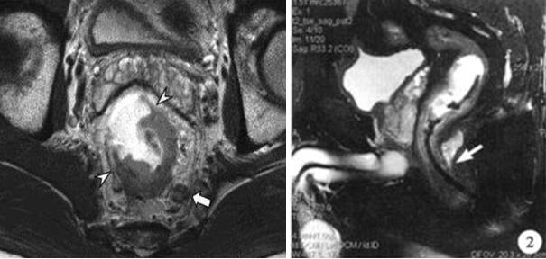 牙齿有金属填充物能不能做磁共振,做磁共振身上带金属会伤害身体吗