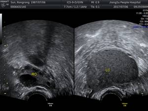 痛经的你要谨慎这六种疾病,痛经淤堵看过来
