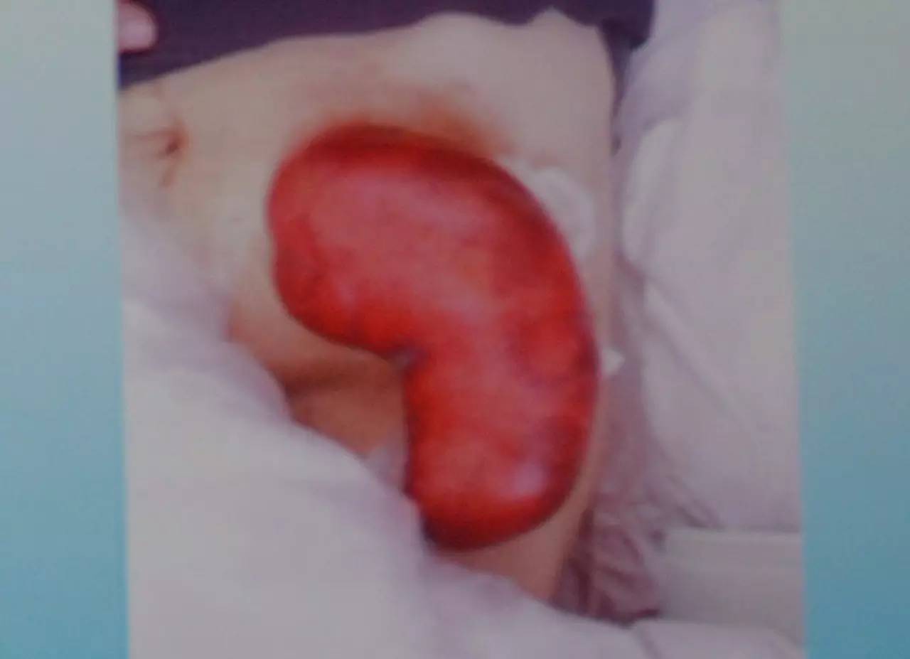 肠造口并发症最新护理文献,肠造口手术的并发症