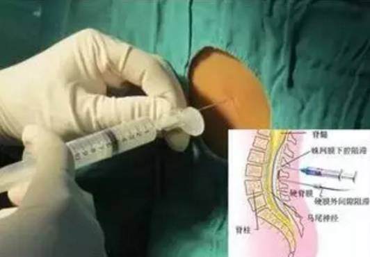 科普一刻｜你真的了解顺产、剖腹产和无痛分娩吗？