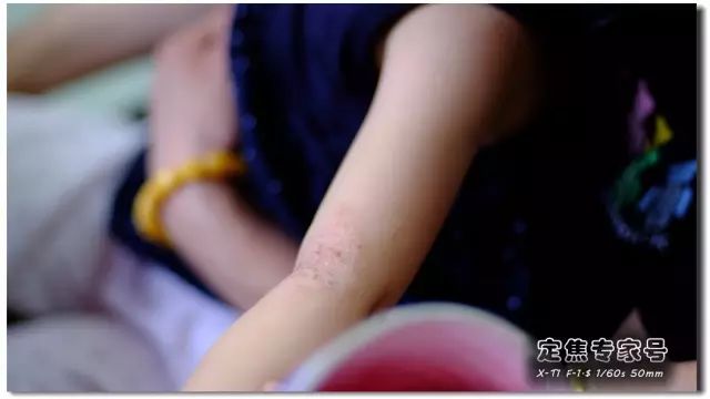 「热点」越是古老的疾病坑越多，一个湿疹能有多少坑把父母掉进去？