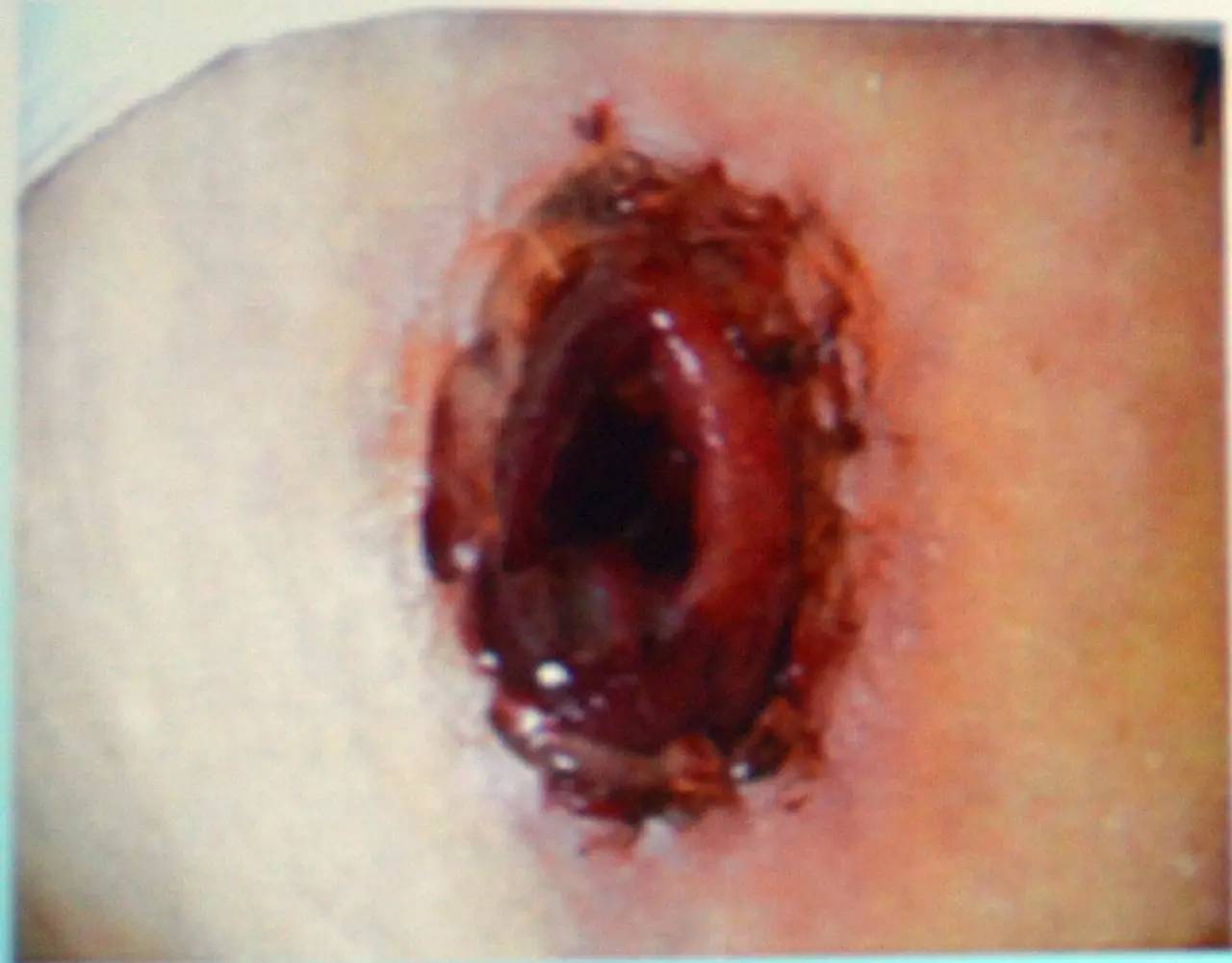 肠造口并发症最新护理文献,肠造口手术的并发症