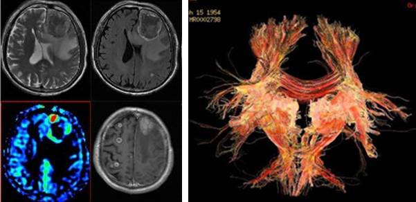 牙齿有金属填充物能不能做磁共振,做磁共振身上带金属会伤害身体吗