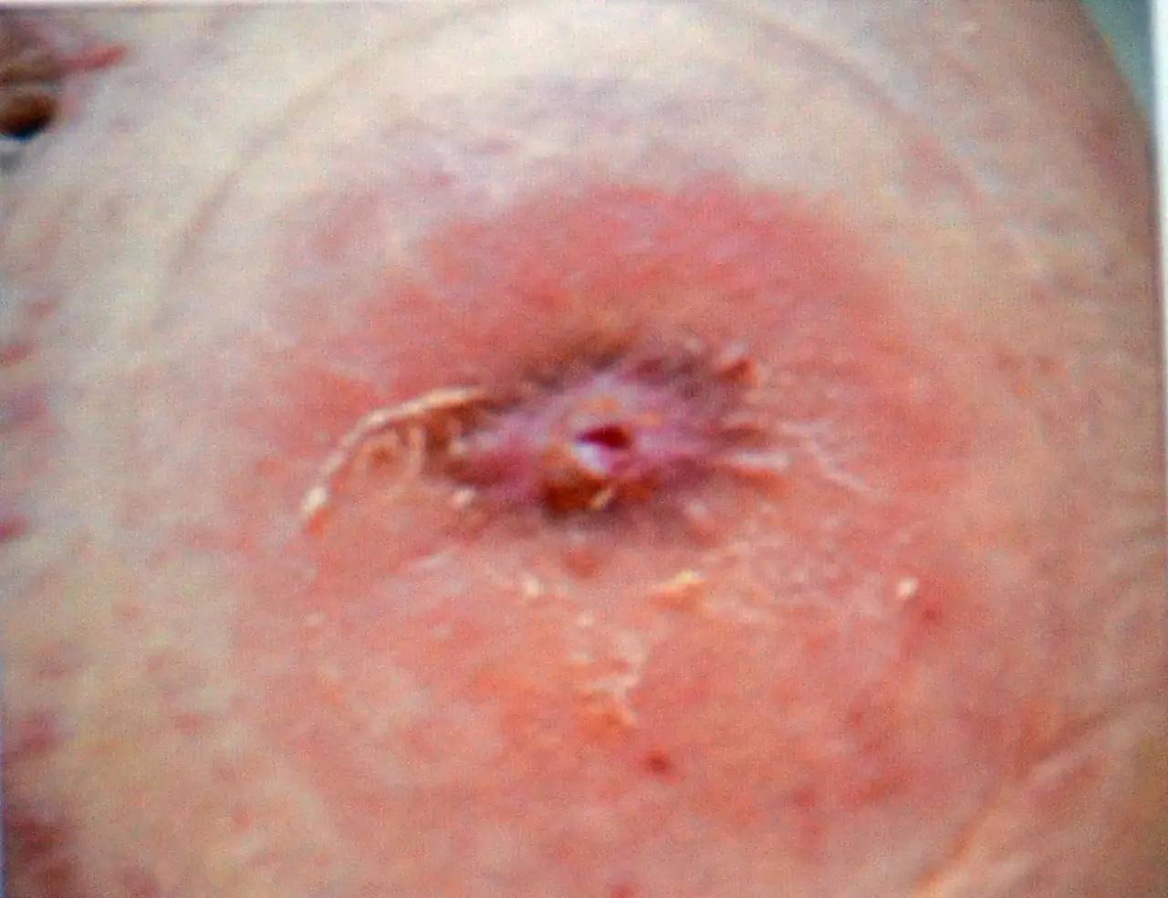 肠造口并发症最新护理文献,肠造口手术的并发症