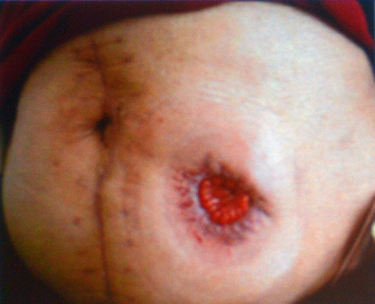 肠造口并发症最新护理文献,肠造口手术的并发症