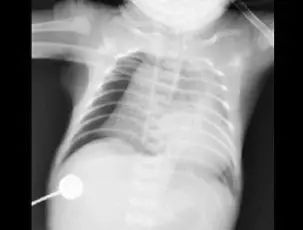 五岁的儿童左肺不翼而飞,一周岁小孩得白肺后遗症