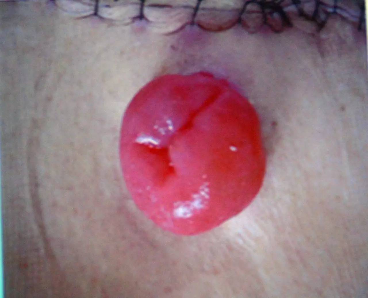 肠造口并发症最新护理文献,肠造口手术的并发症