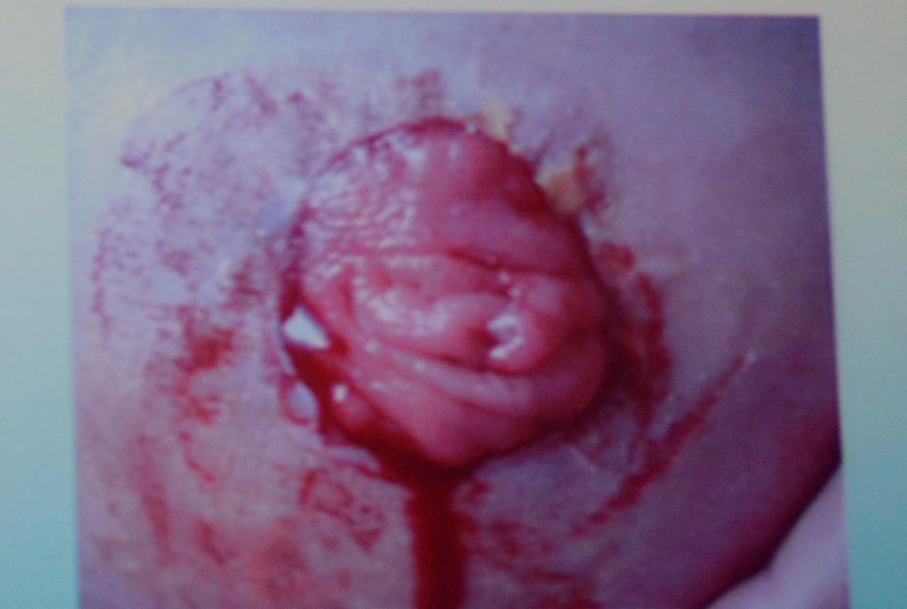 肠造口并发症最新护理文献,肠造口手术的并发症