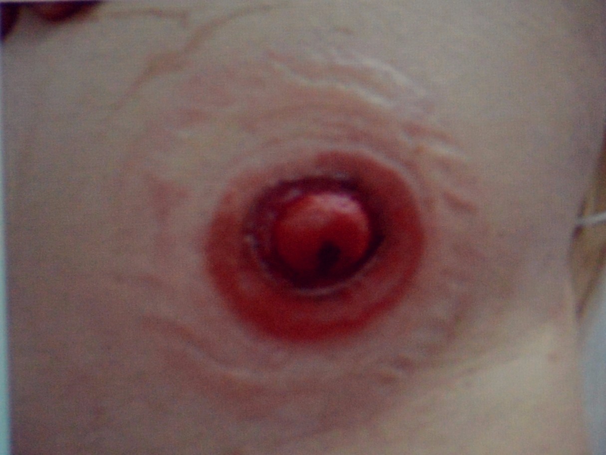 肠造口并发症最新护理文献,肠造口手术的并发症