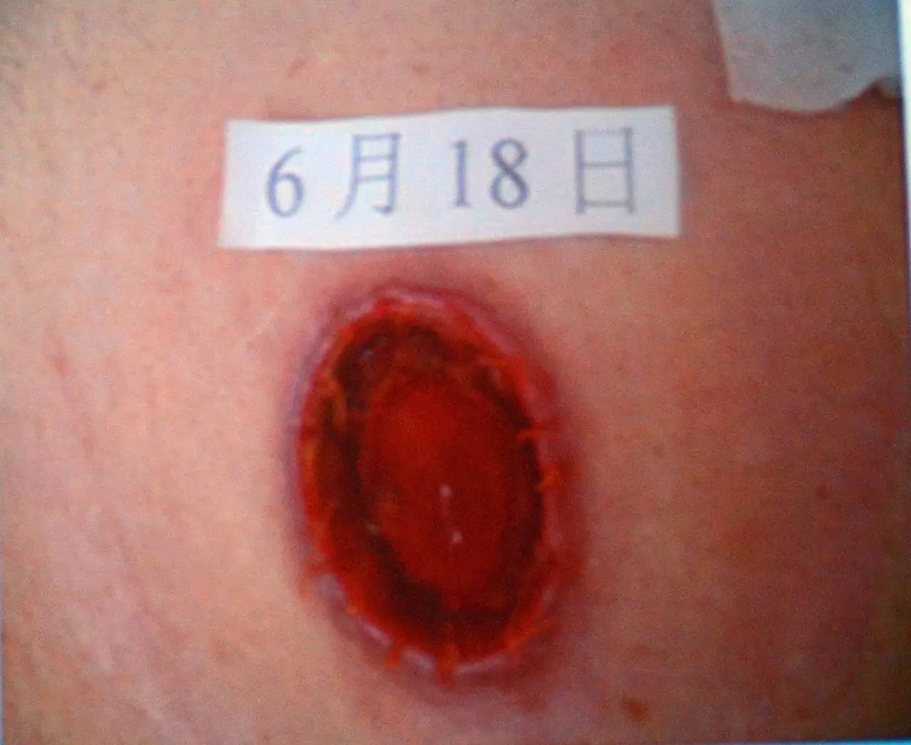 肠造口并发症最新护理文献,肠造口手术的并发症