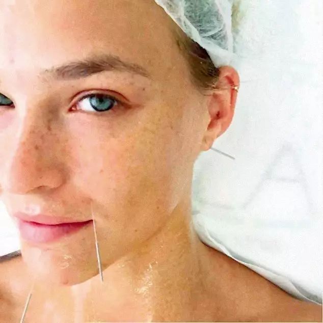 精品话题｜拔罐、针灸，你们的idol“好这口”！