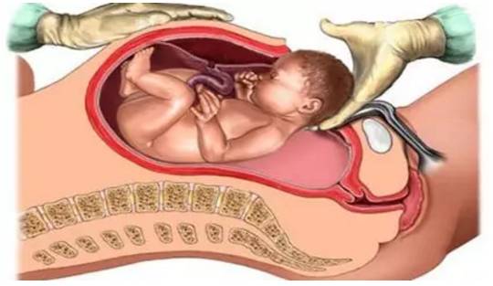科普一刻｜你真的了解顺产、剖腹产和无痛分娩吗？