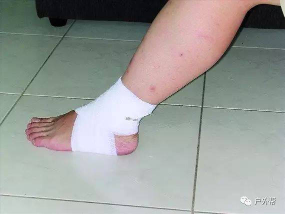 脚踝扭伤怎么处理小视频,野外扭伤脚踝现场急救方法