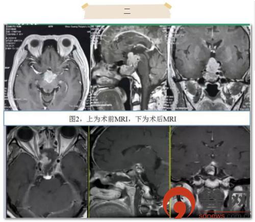 青岛齐鲁医院神经外科住院部,齐鲁医院青岛院区神经内科