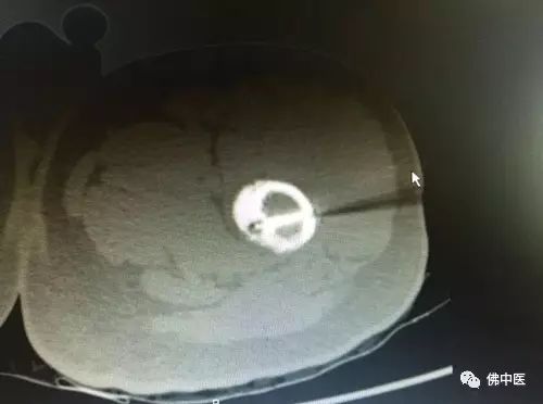 「高超」微创直达深巢，射频消融病灶，佛中医治疗骨样骨瘤有新招