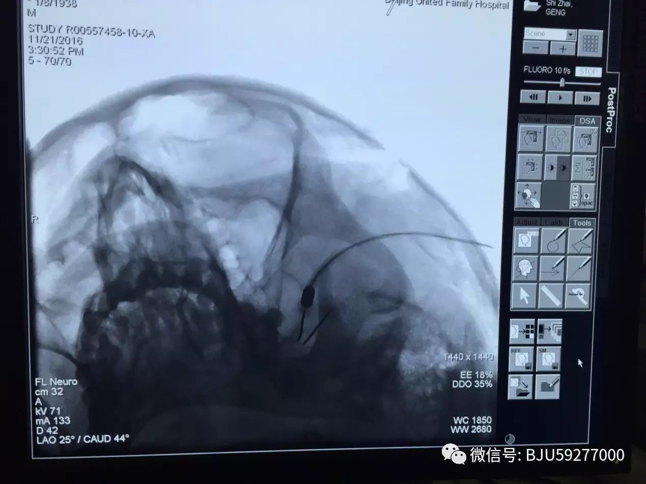 微球囊压迫术治疗三叉神经痛成都,射频热凝治疗三叉神经痛几天出院