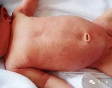 专家在线丨高烧？出疹？腹泻？让家长如临大敌的幼儿急疹，原来是这么一回事！