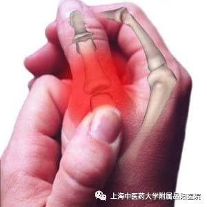 岳阳有专治类风湿的地方吗,岳阳痛风膏方价格表