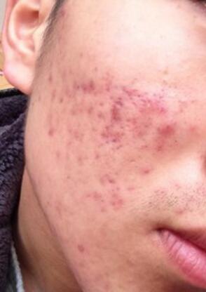 痘印怎么祛除最有效最快方法,痘印怎么去除最有效方法