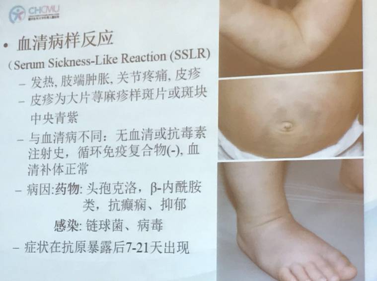 幼儿麻疹的鉴别方法,儿童麻疹的诊断与治疗