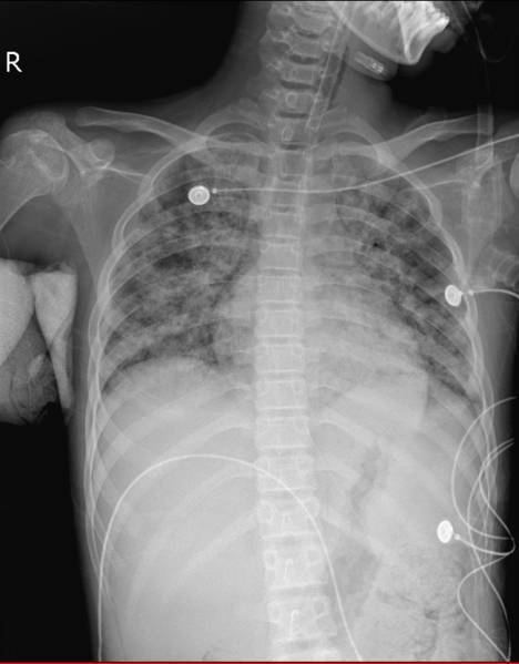 hiv最典型并发症,最新hiv感染治疗的消息