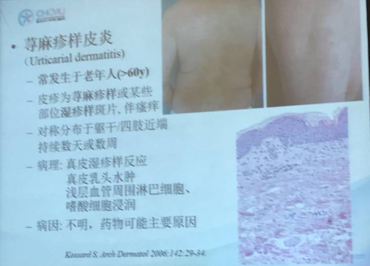 幼儿麻疹的鉴别方法,儿童麻疹的诊断与治疗