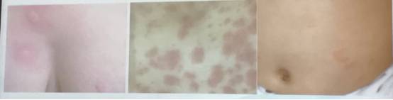 幼儿麻疹的鉴别方法,儿童麻疹的诊断与治疗