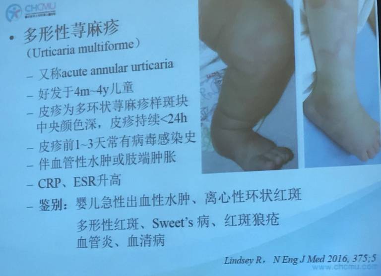 幼儿麻疹的鉴别方法,儿童麻疹的诊断与治疗