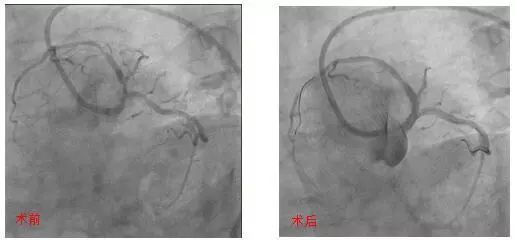 复杂冠状动脉病变,冠状动脉粥样硬化防治